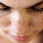 How to get rid of spots quickly