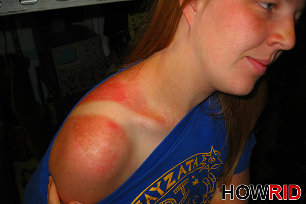How to Get Rid of Sunburn Fast?