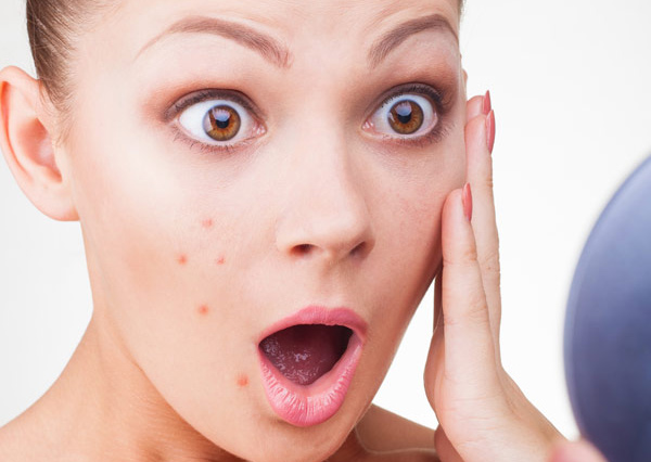 home remedies for pimples and acne treatment