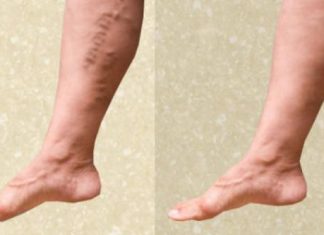 home remedies to trear varicose veins