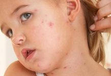 home remedies to treat measles