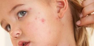 home remedies to treat measles
