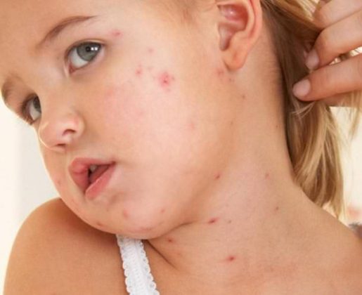 Home Remedies To Treat Measles 