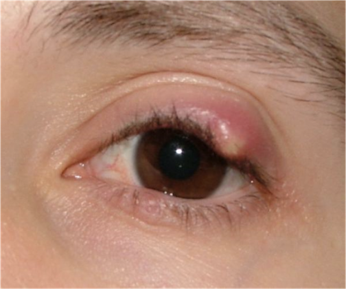 How to Get Rid of a Stye Overnight and Fast?