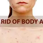 how to get rid of body acne