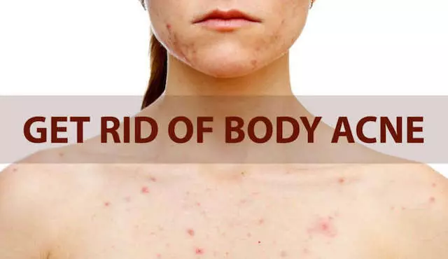 how to get rid of body acne