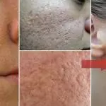 how to get rid of pores reduce large open pores