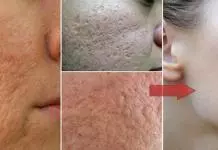 how to get rid of pores reduce large open pores