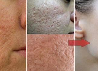 how to get rid of pores reduce large open pores