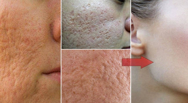 how to get rid of pores reduce large open pores