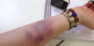 how to heal bruise