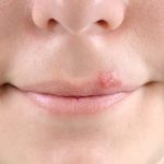 how to heal cold sore naturally