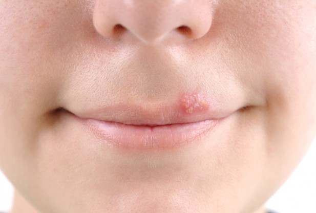 how to heal cold sore naturally