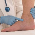 how to prevent varicose veins