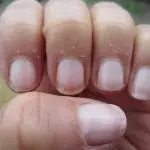 how to stop peeling fingertips home remedies