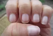 how to stop peeling fingertips home remedies
