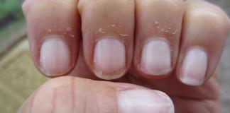 how to stop peeling fingertips home remedies