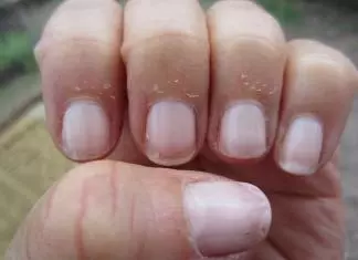 How to Stop Peeling Fingertips? how to stop peeling fingertips home remedies