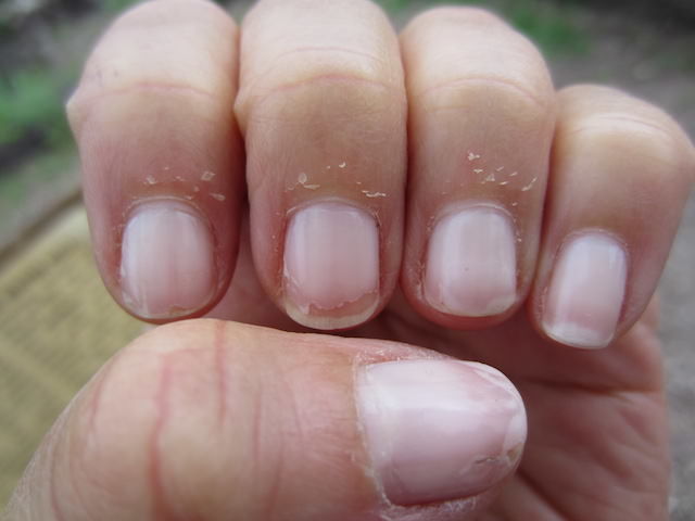 home remedies to stop peeling fingertips