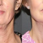 how to tighten loose neck skin