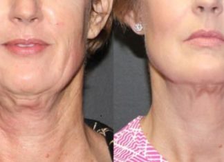 how to tighten loose neck skin