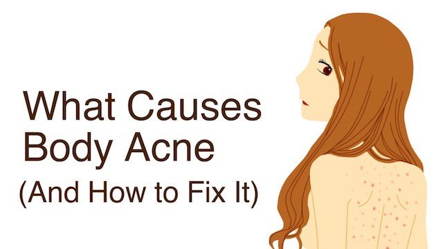 How to get rid of body acne