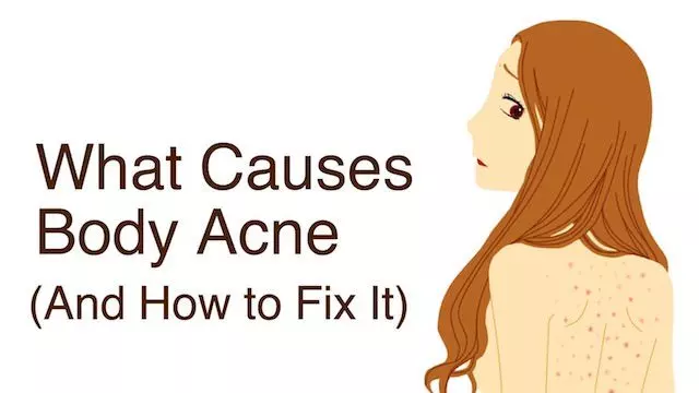 what causes body acne