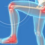 Home Remedies for Joint Pain and Arthritis