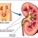 How to Pass a Kidney Stone faster and naturally