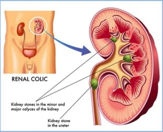 How to Pass a Kidney Stone faster and naturally