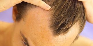How to Treat Male Pattern Baldness Hair Loss