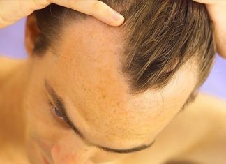 How to Treat Male Pattern Baldness Hair Loss