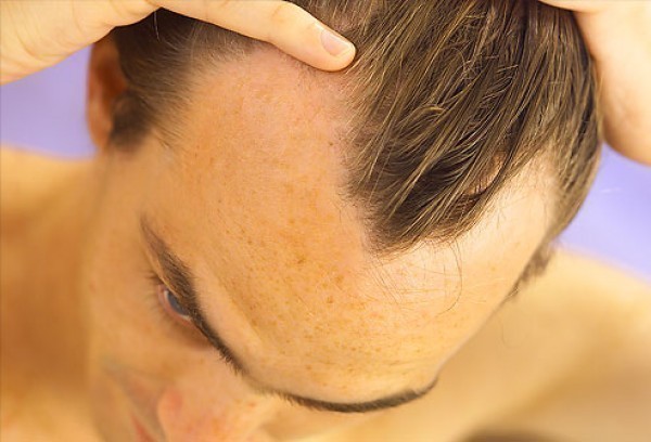 How to Treat Male Pattern Hair Loss?