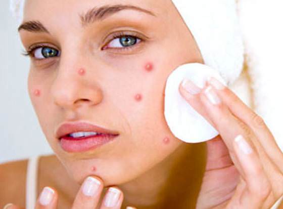 How to get rid of pimples overnight fast naturally
