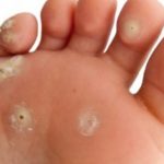get rid of wart at the bottom of the foot