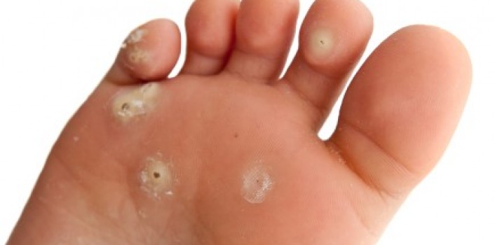how to get rid of wart on the bottom of foot