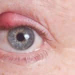 home remedies to treat a stye on the eye naturally