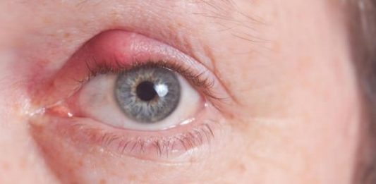 Home Remedies to Treat a Stye On The Eye Naturally