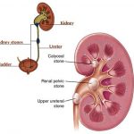home remedies for kidney stones treatment naturally