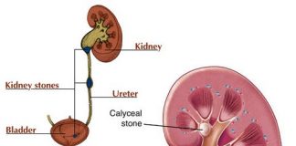 home remedies for kidney stones treatment naturally
