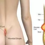 Pilonidal Cyst Home Treatment (Tailbone Cyst) Pilonidal cyst home treatment