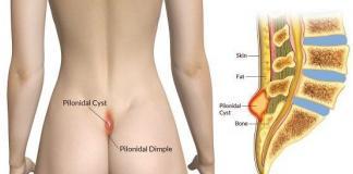 Pilonidal cyst home treatment