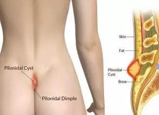Pilonidal cyst home treatment