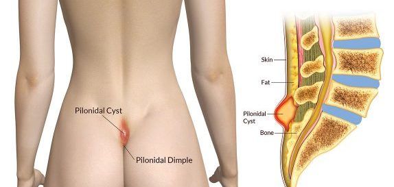 Pilonidal cyst home treatment