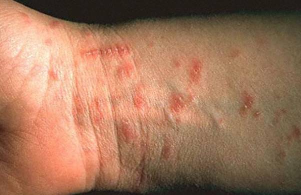 home remedies for scabies treatment