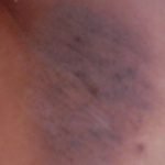 how to get rid of dark underarms