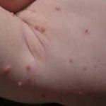 how to get rid of skin tags