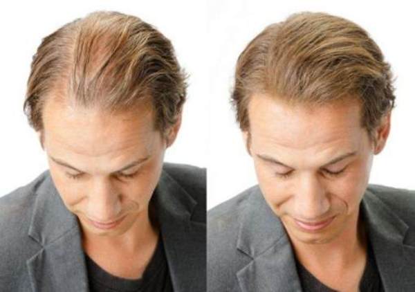How to Treat Thinning Hair