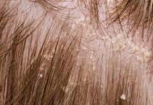 How to get rid of dry scalp