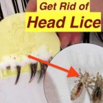 How to get rid of lice